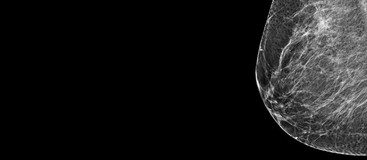 Xray of the breast