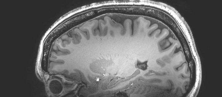 Black and white image of a brain